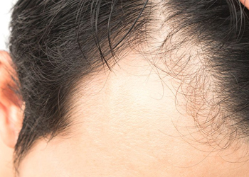 Alopecia Areata Treament