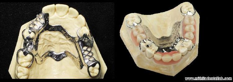 Cast Partial Dentures