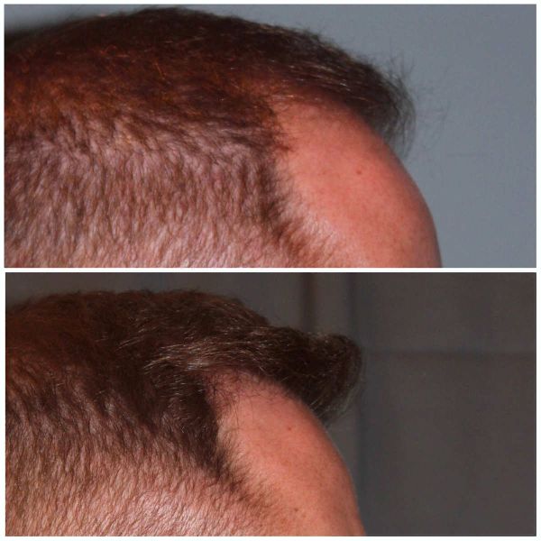 Hair Transplantation