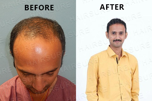 Best Hair Transplant Clinic in Surat || HairFree HairGrow Clinic Surat  Result - YouTube