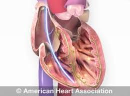 Implantable Cardioverter Defibrillators, Certification : ISO 9001:2008