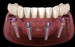  0-10gm dental implants, for Lab Use