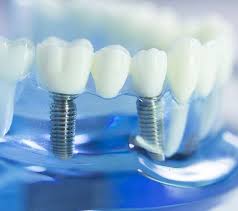 0-10gm dental implants, for Lab Use