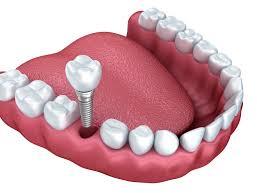 0-10gm dental implants, for Lab Use