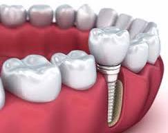  0-10gm dental implants, for Lab Use