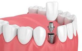  0-10gm dental implants, for Lab Use