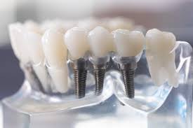  Dental implants, for Lab Use, Color : Brown, Grey, Light White, White