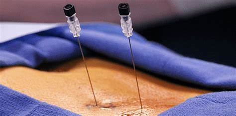 epidural injection