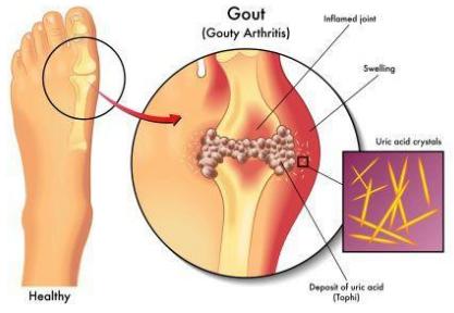 Gout Treatment Services