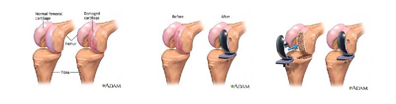 Partial Knee Replacement Surgery