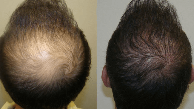 Artificial Hair Transplants - Derma Miracle, Delhi, Delhi