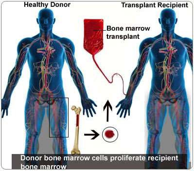 Bone Marrow Transplant In Delhi
