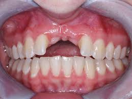 Immediate Teeth Implants Service