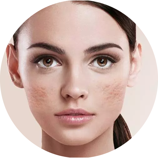 Acne Scars Treatment YCDC Clinic, Bangalore, Karnataka