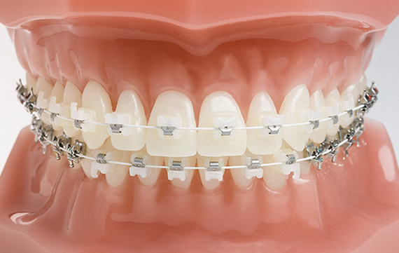 Ceramic Braces at Best Price in Vijayawada