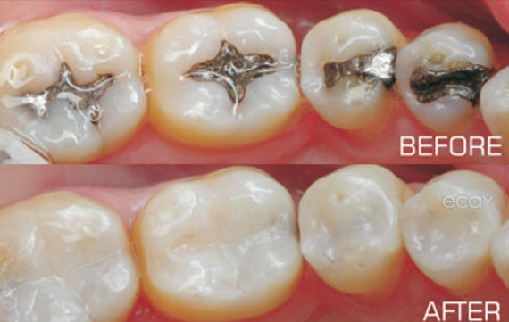 Tooth Colored Restorations