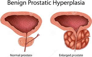 Benign Enlargement Treatment Services