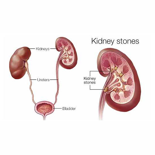 Kidney Stone Treatment Services