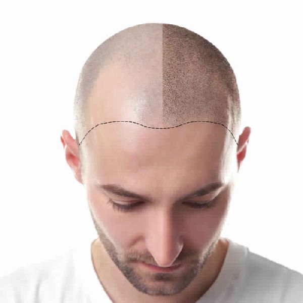Hair Transplantation Treatment Services at best price in Pathanamthitta  Kerala from Medlounges Wellness center | ID:5406131