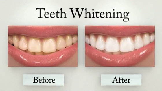 Teeth Whitening Services