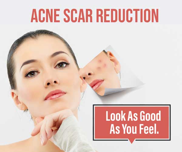 Acne Scar Reduction Surgery Service