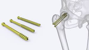 Stainless Steel Cannulated Screws, for Hospital, Orthopaedia
