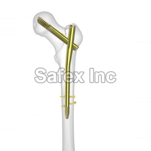 Stainless Steel Polished PFNA Nail, for Clinical, Hospital, Feature : Disposable, Easy To Use