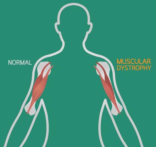 Muscular dystrophy ayurvedic treatment