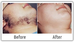 Chin Laser Hair Removal Services
