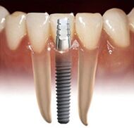 Dental implants