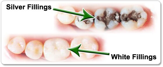 Tooth Filling Treatment Services