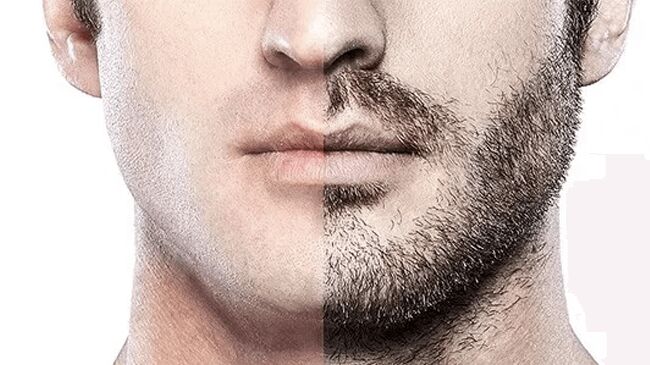 Beard &amp; Moustache Transplant