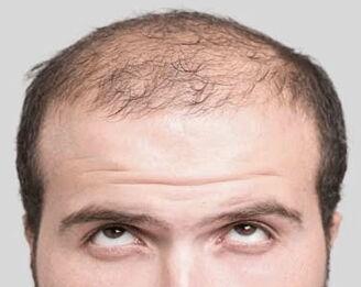 Male Pattern Baldness Treatment