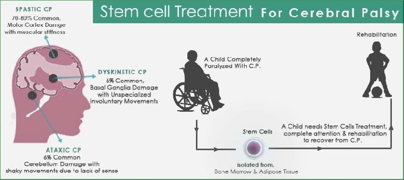 Stem Cell Treatment for Cerebral Palsy