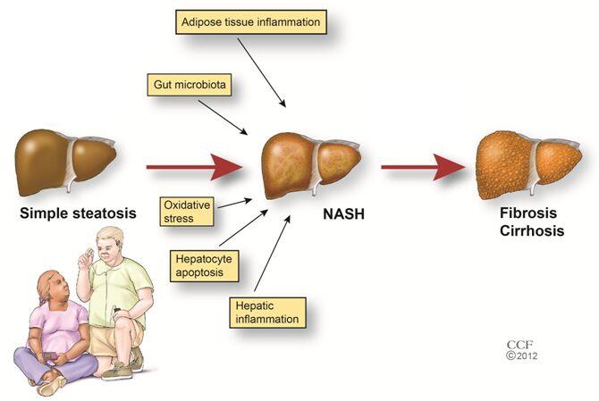 Non Alcoholic Fatty Liver Disease Treatment