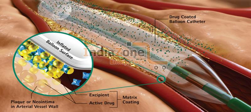 Drug Eluting Balloon