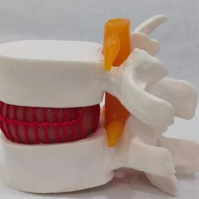 Disc Prolapse Simulator