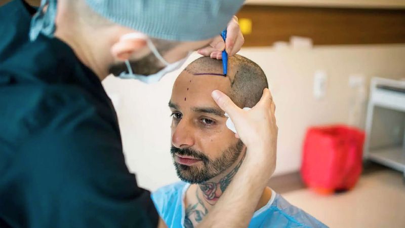 Hair Transplant in Delhi