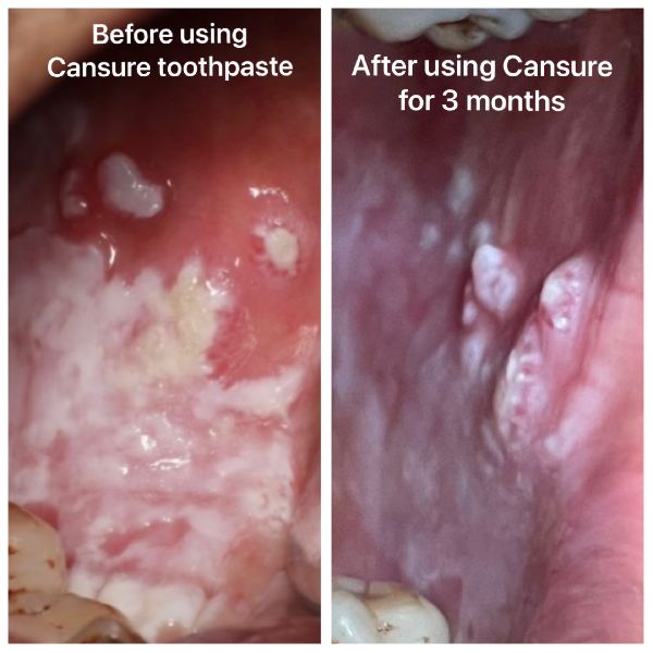 Cansure Herbal Tooth Paste