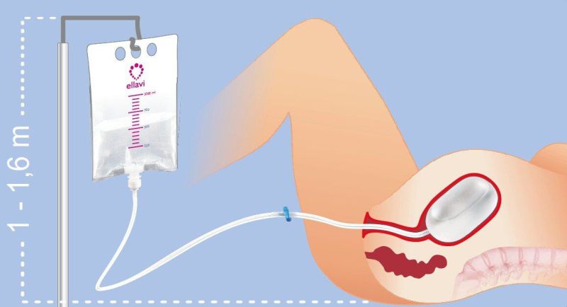 Ellavi Uterine Balloon Tamponade Ellavi Uterine Balloon Tamponade Pph Due To Atonic Uterus