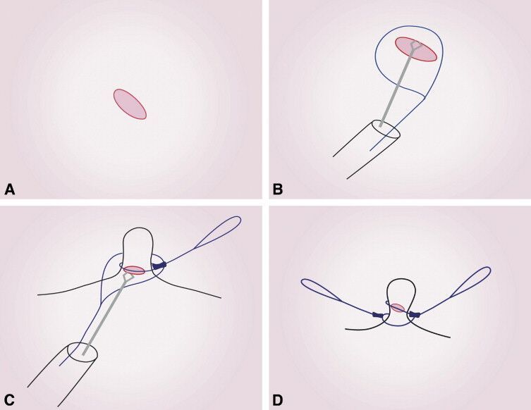 Laparoscopic Appendectomy Endoloop