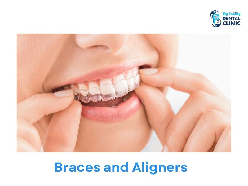 Braces and Aligners