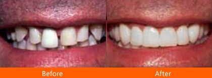 Digital Smile Designing Service