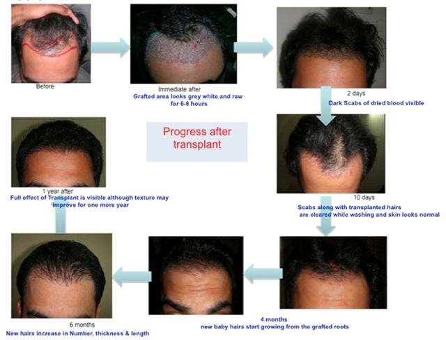 Process After Hair Transplant