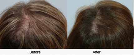 Female Hair Transplant Treatment