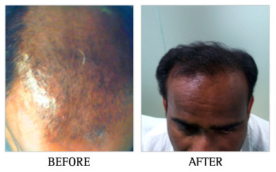 Hair Fall Clinic in Bangalore - Hairline International Clinic, Bangalore,  Karnataka