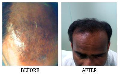 Prp for Hair Loss in Bangalore, Platelet Rich Plasma for Hair Loss