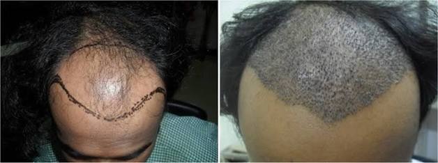 Hair Tranceplante & treatment