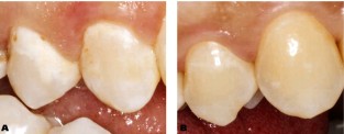 Early Caries Detection Tests