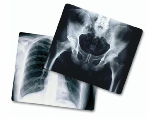 Medical X-Ray Films